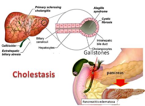 bile leakage symptoms|Cholestasis: Definition, Symptoms, Treatment, Causes